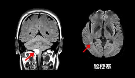 頭部 MRI 画像