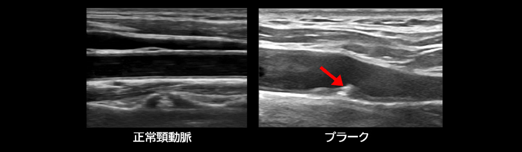 頸動脈エコー画像